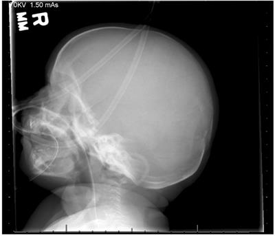 A novel termination site in a case of Stüve–Wiedemann syndrome: case report and review of literature